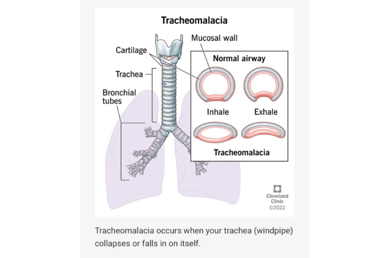 A Rare and Hidden Airway Problem: How Bronchoscopy on NIV Helped Diagnose Adult Tracheomalacia