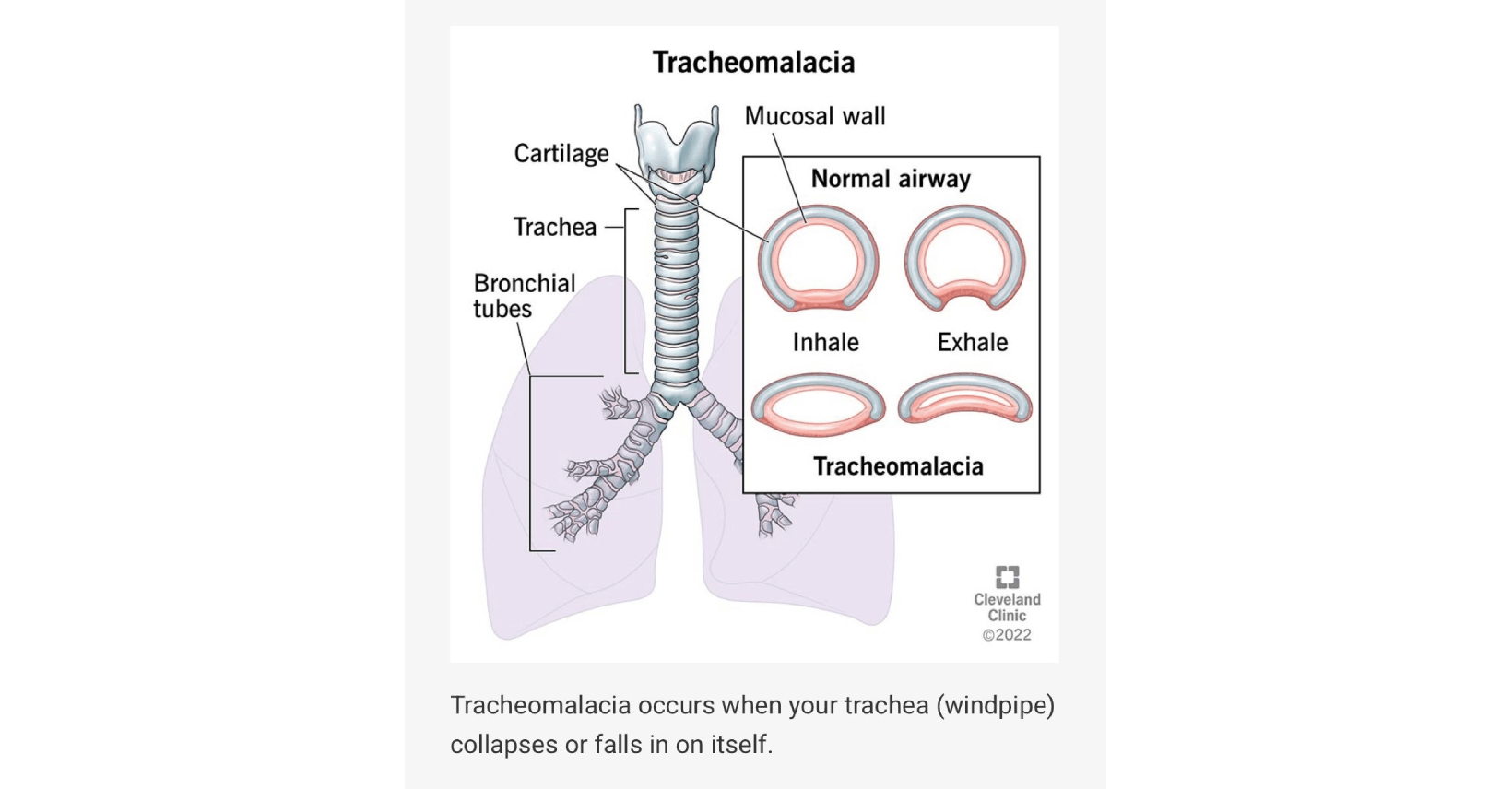 A Rare and Hidden Airway Problem: How Bronchoscopy on NIV Helped Diagnose Adult Tracheomalacia