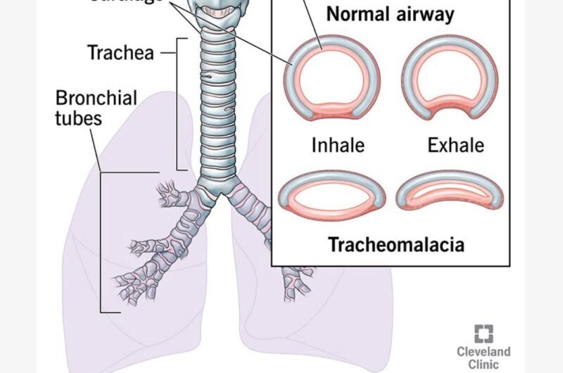 A Rare and Hidden Airway Problem: How Bronchoscopy on NIV Helped Diagnose Adult Tracheomalacia