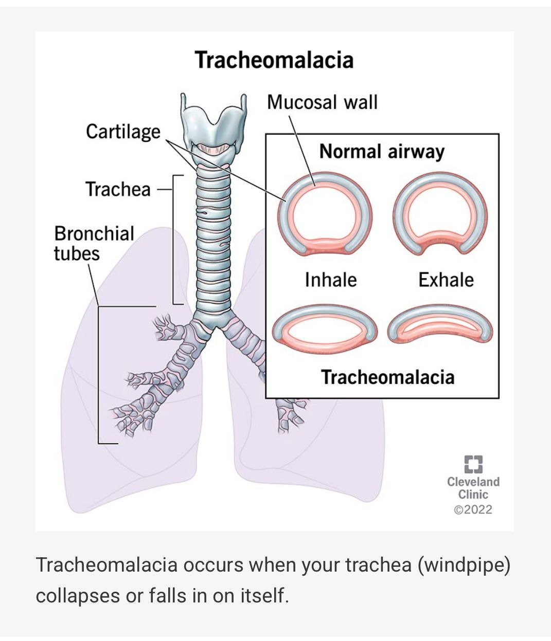 A Rare and Hidden Airway Problem: How Bronchoscopy on NIV Helped Diagnose Adult Tracheomalacia