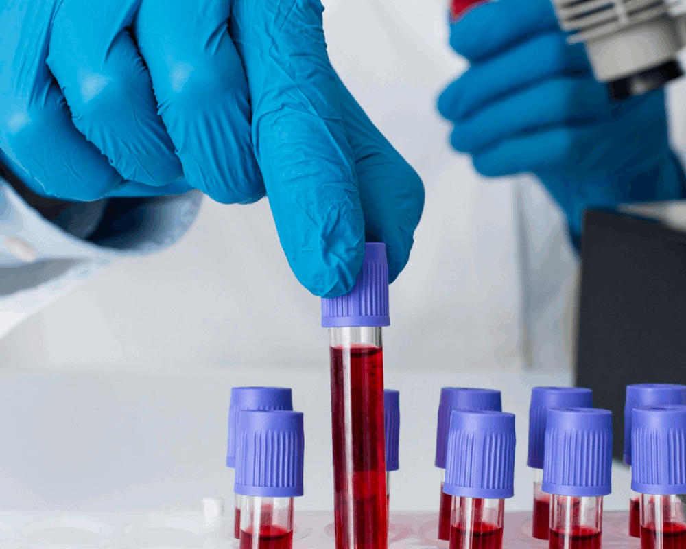 Hematology: Early Detection for Effective Blood Disease Treatment