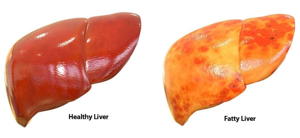 What Is the Damage to the Liver with Fatty Liver? Causes, Symptoms & Treatment